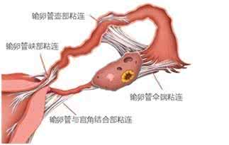 治疗女性输卵管粘连 女性输卵管粘连治的好吗
