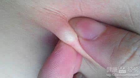 脂肪瘤图片 脂肪瘤 脂肪瘤图片