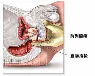 前列腺囊肿会癌变吗 关于前列腺与癌变