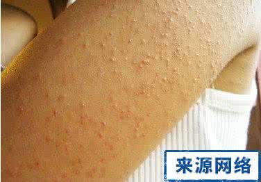 毛囊角化症症状 毛囊角化症的症状 毛囊角化 患上它会有哪些症状