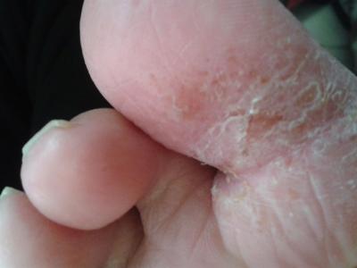 脚气怎么根治偏方白醋 脚气怎么根治偏方白醋 想治好脚气，千万别相信这些脚气偏方！