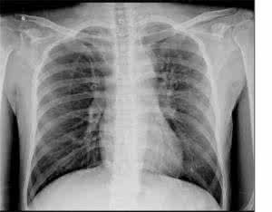 肺癌骨转移死前症状 肺癌骨转移死前症状是什么