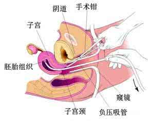 做人流的手术过程 人流手术全过程 女人怎么做人流