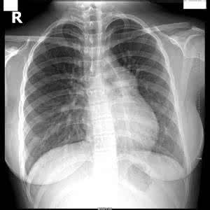 继发性肺动脉高压 继发性肺动脉高压 继发性肺动脉高压概述