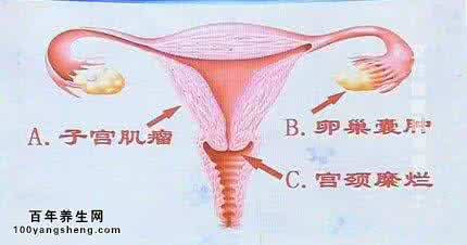 健康之路卵巢囊肿 健康之路卵巢囊肿 用6方法“筑造”健康卵巢