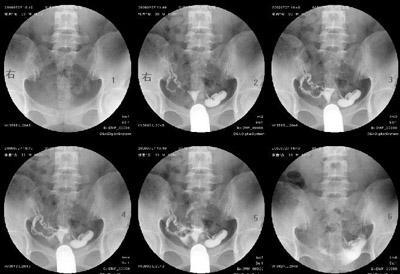 做完输卵管造影后饮食 做完输卵管造影后注意什么呢