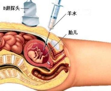 羊水穿刺准确率 准妈羊水破了容易犯的三个错误