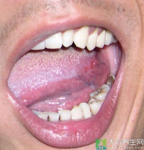 舌头肿大是怎么回事 舌头下肿大怎么回事?