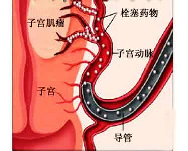 子宫动脉高要多运动吗 子宫动脉高要多运动吗？