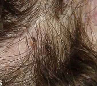 阴虱立扫光 扫光机 阴虱立扫光