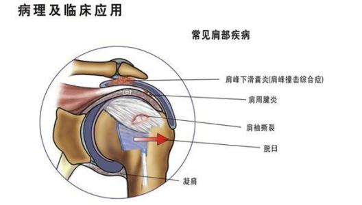 治疗肩周炎的简单方法 太简单：肩周炎的自我康复操（附具体教程）