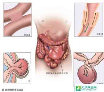 肠梗阻是怎么引起的 肠梗阻的症状