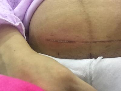 刨腹产后吃什么最下奶 刨腹产喝开水下奶吗?