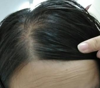 年轻人掉头发怎么回事 老是掉头发咋回事 年轻人老是掉头发怎么回事
