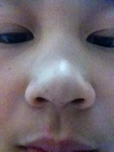 鼻孔干疼怎么办 鼻孔疼 鼻孔疼应该怎么办