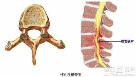 腰椎间盘滑脱椎管狭窄 图文：腰椎间盘、椎管狭窄，“土元”一味显神奇！（转）