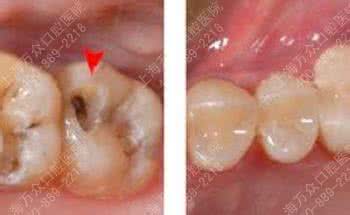 牙周炎和蛀牙有啥区别 蛀牙牙疼怎么办--牙周炎的危害