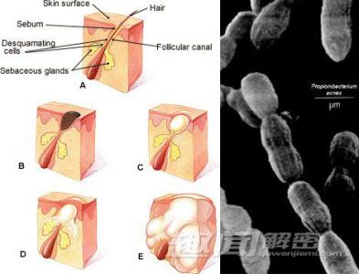 hiv致病机制 痤疮丙酸杆菌 痤疮丙酸杆菌致病机制