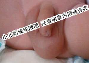 小儿鞘膜积液手术过程 小儿鞘膜积液的治疗方法