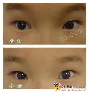 间歇性外斜视治疗 间歇性外斜视 如何治疗间歇性外斜视