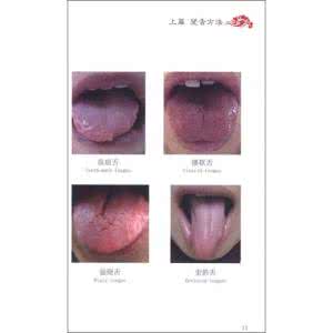 图解舌诊 22种舌诊图解