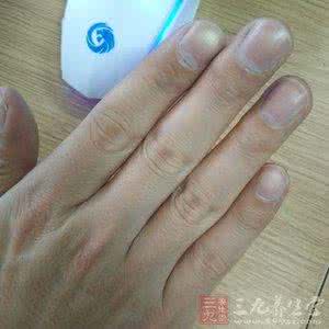 手脱皮是缺什么维生素 手脱皮是缺什么 原来手脱皮是缺它们