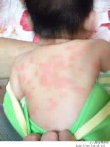哪里治疗荨麻疹效果好 哪里治疗荨麻疹效果好 什么药治疗荨麻疹效果好？