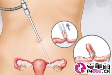 结扎对女性的影响 【结扎对女性的影响】心事心情 _心事心情