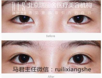 济南开内眼角手术价格 开眼角手术价格 2014开眼角手术价格