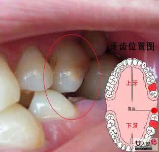牙龈肿痛吃什么药 牙龈肿痛是怎么回事？牙龈肿痛吃什么药