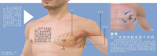 死于乳腺癌的名人 烟台5名男性死于乳腺癌 55至60岁最需警惕