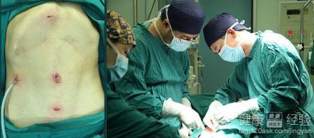 胆结石手术后注意事项 胆结石手术后注意事项 胆结石术后护理