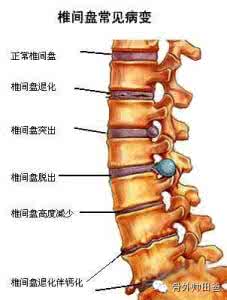 腰椎间盘突出症的医院 【家庭医苑】临床常见病==腰椎间盘突出症