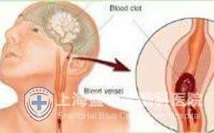 脑血栓的治疗方法 脑血栓治疗方法 中西医结合治疗脑血栓