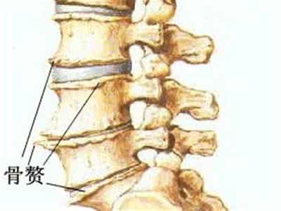 腰椎骨刺的症状是什么 腰椎骨刺的症状是什么 骨神经纤维瘤的症状是什么