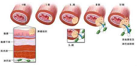 食道癌的早期症状 远离食道癌 忌冷热交替防食道疾病