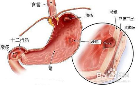 胃窦隆起病变要切除吗 胃窦癌前病变要切除吗？