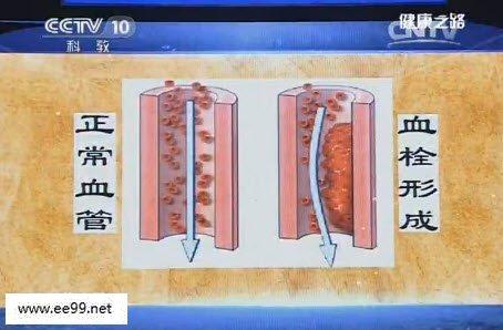健康之路甲状腺癌 20160416健康之路视频和笔记:王晓雷,甲状腺癌,甲状腺结节,穿刺