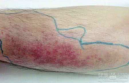 治疗膝关节疼痛小偏方 蜂窝组织炎 小偏方有效治疗蜂窝组织炎