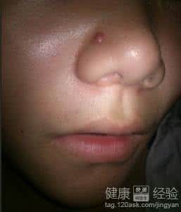 鼻子长痘痘的原因 鼻子长痘痘的原因 鼻子上长痘痘原因？