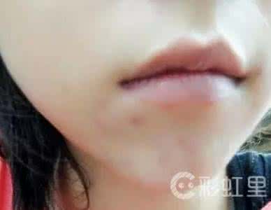 下巴长痘痘是什么原因 下巴长痘痘是什么原因 造成你长痘痘的原因有那些