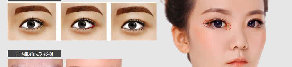 韩式无痕开眼角 韩式无痕开眼角 韩式无痕，有线，开了眼角