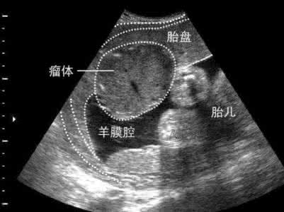 孩子们来到了孕妇课堂 【孕妇课堂】第42课:孕晚期B超查什么