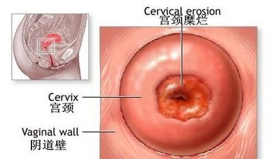 宫颈妊娠治疗 宫颈妊娠治疗 宫颈妊娠的治疗护理