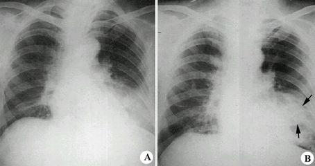 大叶性肺炎如何治疗 大叶性肺炎如何治疗 如何治疗大叶性肺炎效果好