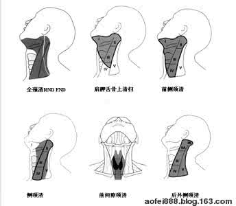 颈部淋巴结分区 颈部淋巴结分区 颈清扫术的分类