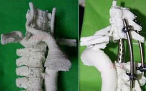 乳房切除重建 医院用3D打印完成高难度胸椎切除重建术