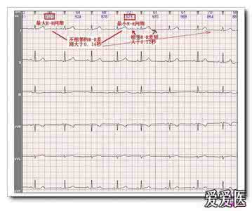 山羊老师心电图讲座 山羊老师课程常见心电图诊断知识讲座第十四讲——窦性心律失常
