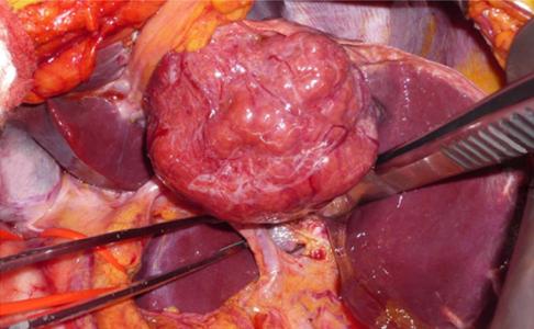 肝脏良性肿瘤 良性肿瘤的治疗方法 肝脏良性肿瘤有哪些 肝脏肿瘤的治疗方法