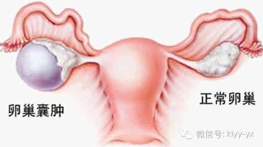 怎样预防卵巢囊肿 卵巢囊肿的原因 女士要预防不得不知的6个方面